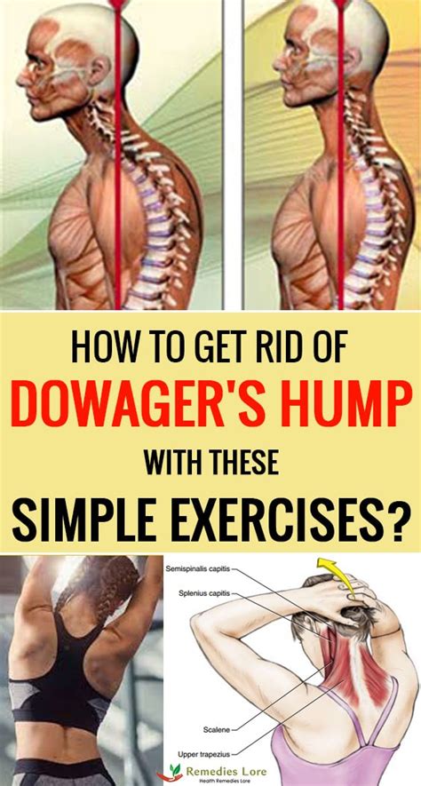 Dowagers Hump Simple Exercises