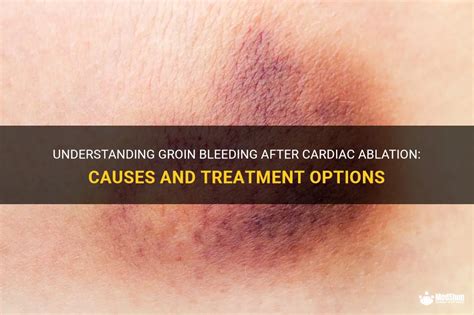 Understanding Groin Bleeding After Cardiac Ablation Causes And Treatment Options Medshun