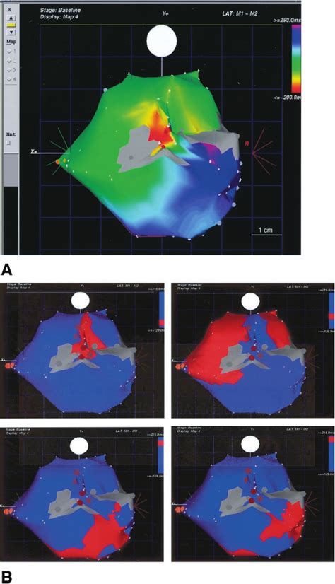 Three Dimensional Electroanatomic Maps And Entrainment Mapping Of Iart