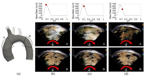 In Vitro Analysis Of Hemodynamics In The Ascending Thoracic Aorta