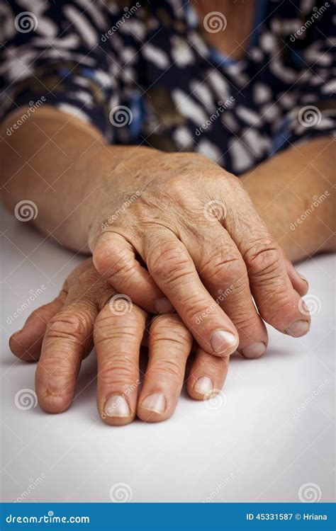 Hands Of Woman Deformed From Rheumatoid Arthritis Stock Photo - Image ...