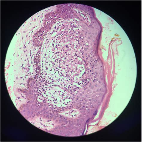 Histopathology showing noncaseating granuloma. | Download Scientific ...