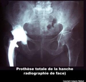 Hanche Proth Se Totale Radiographie Anatomie Photo Et Illustration