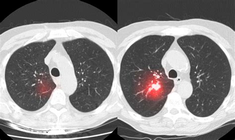 How Artificial Intelligence Is Being Used To Detect Treat Cancer