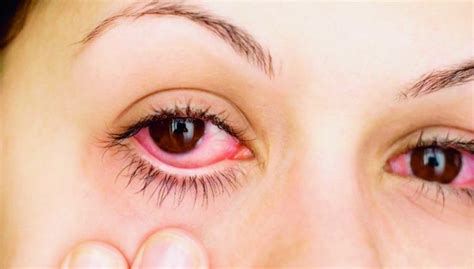 Conjuntivitis Infecciosas Bacterial Y Viral S Ntomas Causas Y