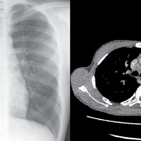 A Chest X Ray Posteroanterior View Showing A Widened Paratracheal