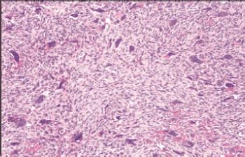 Giant Cell Fibroma Histology