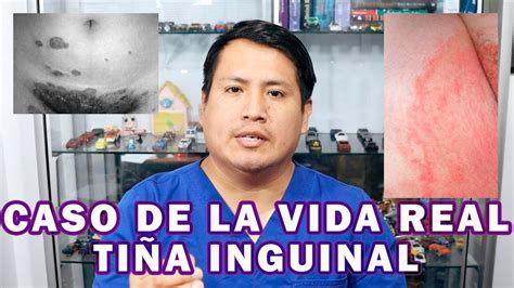 Como Eliminar La TiÑa Inguinal Youtube