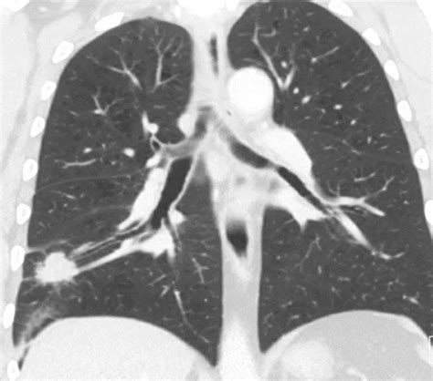 Radial Endobronchial Ultrasound | Thoracic Key