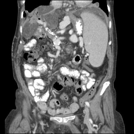 Portal Vein Thrombosis MRI