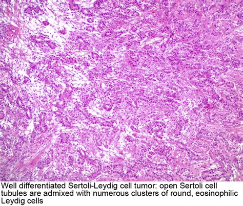 Pathology Outlines Sertoli Leydig Cell Tumor