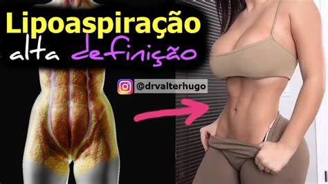 Lipo Hd E Lipoaspira O Alta Defini O Barriga Definida Feminina Antes