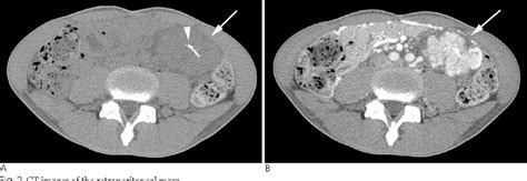 Figure 2 From The Stroma Rich Variant Subtype Of Castleman S Disease In The Retroperitoneum A