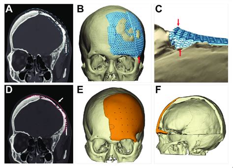 Three Dimensional Reconstruction Of Head Ct Before Surgery And Computer