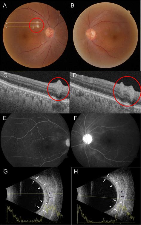 Toxocariasis Retina