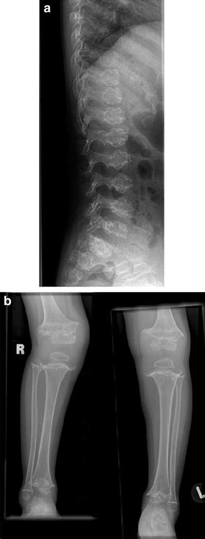 Radiographs Of A 5 Year Old Girl With Pseudoachondroplasia PSACH The