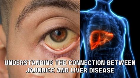 Understanding The Connection Between Jaundice And Liver Disease ଆଜିକାଲି