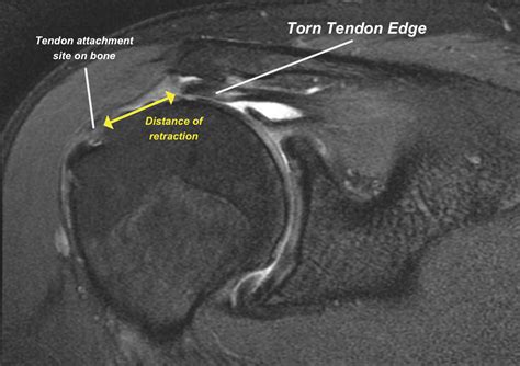 Acute Tears Of The Rotator Cuff Why Seek Help Immediately Shoulder