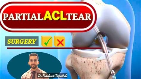 Partial Acl Tear Youtube