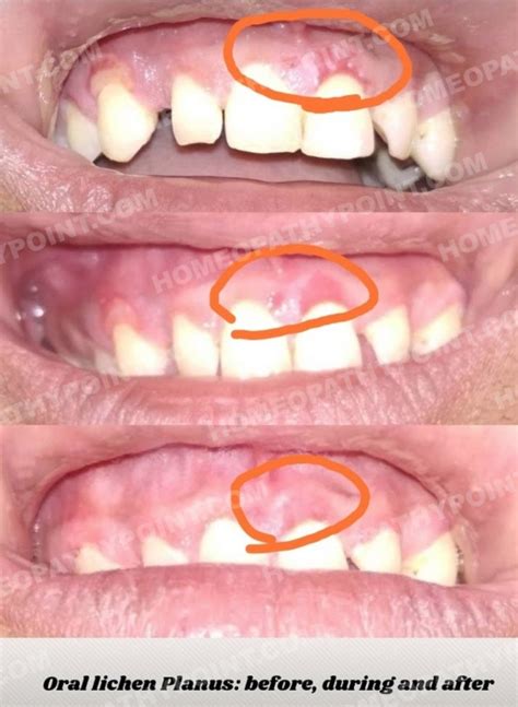 Oral Lichen Planus A Case Report Homeopathypoint