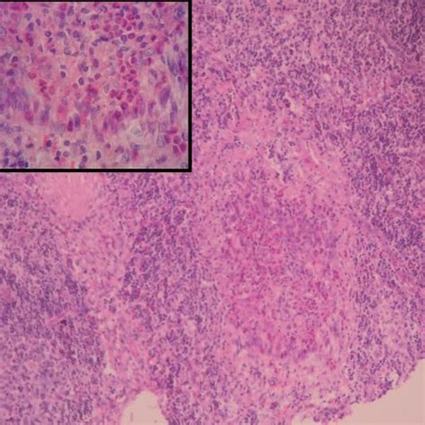 Photomicrograph Of A Cervical Lymph Node Biopsy Lymph Node Biopsy