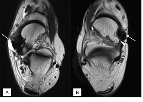 Figure From Imaging Of Posterior Tibial Tendon Dysfunction