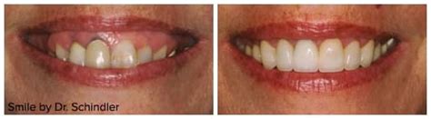 Laser Gum Re Contouring In Columbus Oh Dr Sharon Schindler