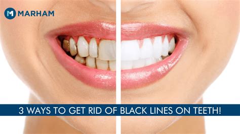 Can You Remove Black Lines On Teeth At Home Marham