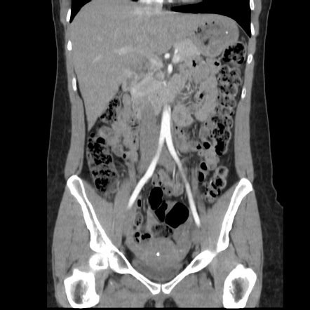 Ct Abdomen Pelvis Protocol Radiology Reference Article