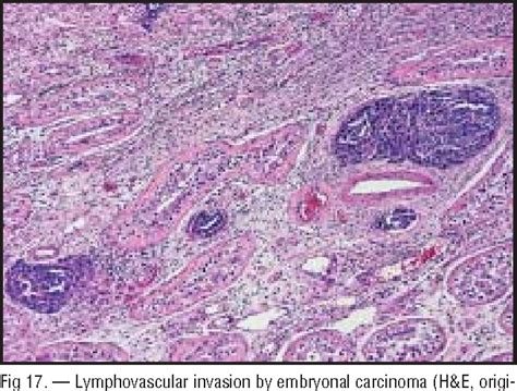 Figure 1 from Pathology of germ cell tumors of the testis. | Semantic ...