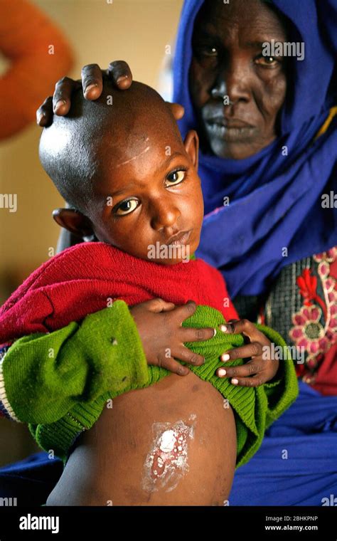 A Young Boy Suffering From Leprosy The Young Child Has A Small Abcess