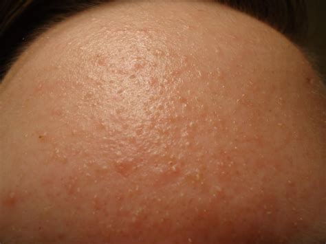 Forehead Rash