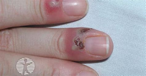 Herpetic Whitlow Image