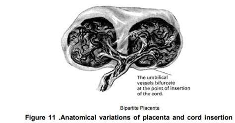 Placenta Bipartita