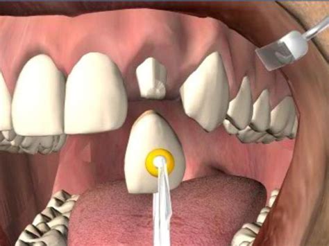 How Long do Dental Crowns Last on Front Teeth? – Mickleham Dental – Medium