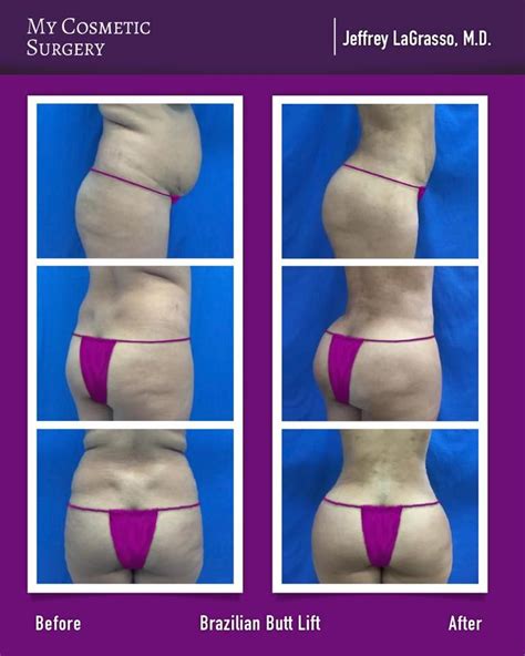 List Pictures Brazilian Buttock Lift Before After Photos Excellent