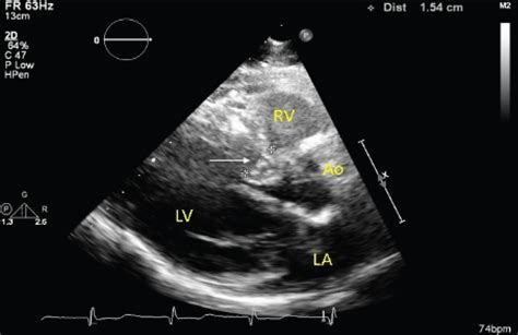 Left Atrial Myxoma And Systolic Anterior Motion Of The Mitral Valve