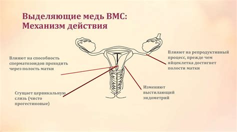 Внутриматочные средства (ВМС) - презентация онлайн