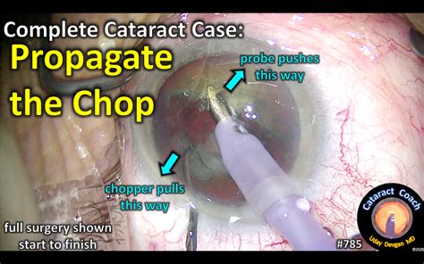 Complete Case Propagate The Chop Cataract Coach