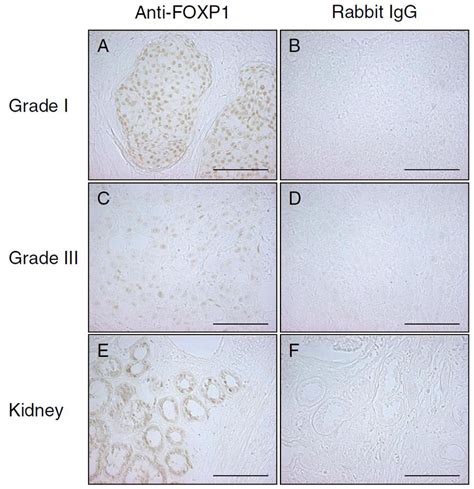 Immunohistochemical Staining Of Samples Of Breast Tumour Tissues