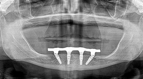 All On Dental Implant Brace Orthodontics And Dental Care With Dr Rahman