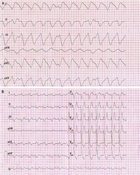 An Electrocardiographic Sine Wave In Hyperkalemia Nejm