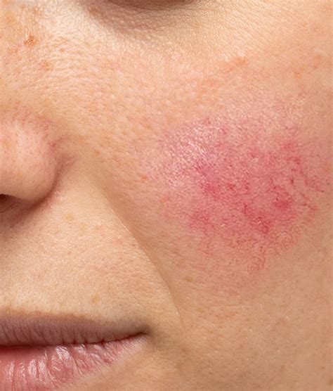 Rosacea Treatments Erie Pennsylvania Iaesthetic Medspa