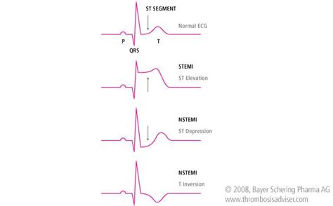 STEMI vs NSTEMI Oncology Nursing, Cardiac Nursing, Nursing School, Np School, Stemi Vs Nstemi ...