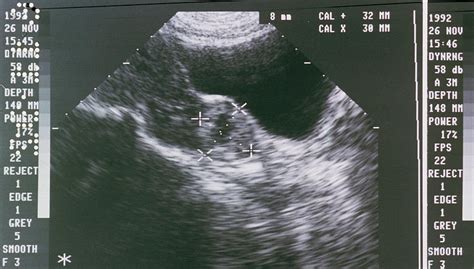 Ectopic Pregnancy Ultrasound