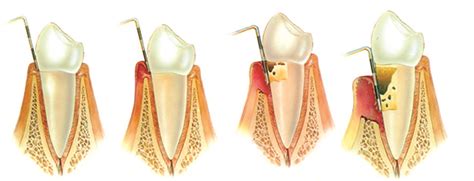 Periodontics Treatment Periodontal Gum Disease Treatments