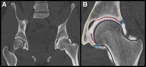 Inclusion Of The Acetabular Labrum Reduces Simulated Range Of Motion Of