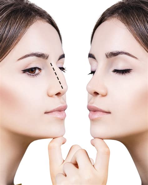 Facial Plastic Surgery Los Angeles And Glendale Dr Michael Bublik