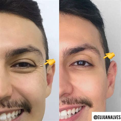 BOTOX MASCULINO CONFIRA MEU ANTES E DEPOIS NA ÁREA DOS OLHOS Homens