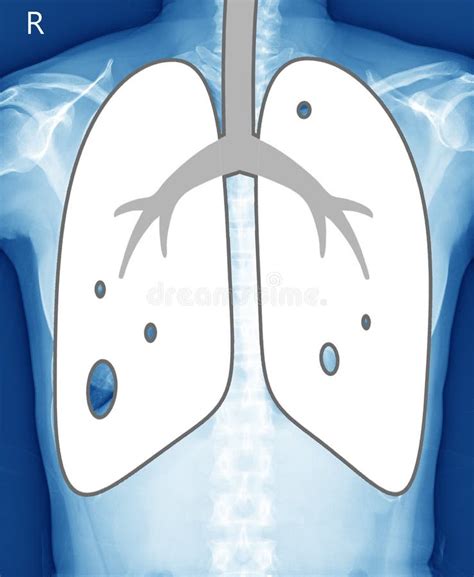 Xray Image Of Human Healthy Chest Looks Narmal Medical Image Concept